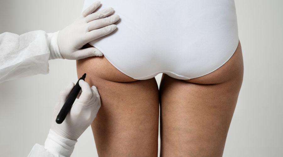 Trattamento della Cellulite a Grosseto. Centro Hermes propone trattamenti di Medicina Estetica Avanzata. Prenota la tua consulenza.